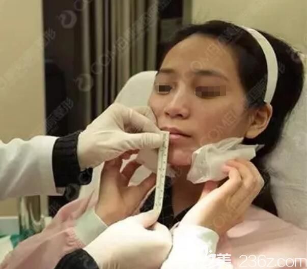 注射玻尿酸+瘦臉微整過程中