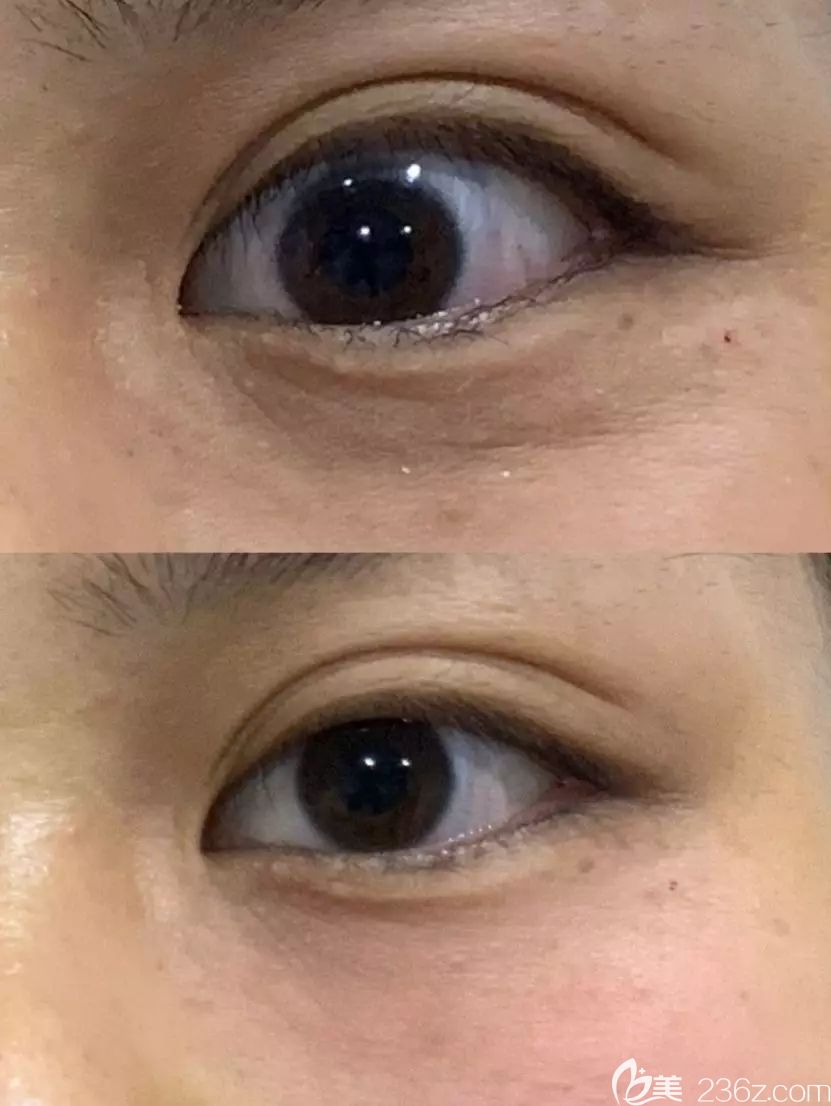 白雪蓮眼部除皺案例對比 白雪蓮眼部除皺案例對比