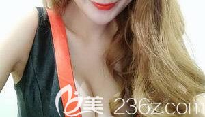 南云醫(yī)院做的自體脂肪豐胸一個(gè)月 南云醫(yī)院做的自體脂肪豐胸一個(gè)月