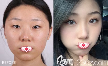 來看邯鄲維多利亞整形3月8日女神節(jié)超值優(yōu)惠美麗攻略 1680元就能get自然款雙眼皮