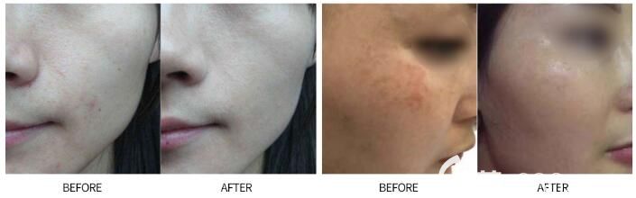 陳秀琴醫(yī)生祛痘案例