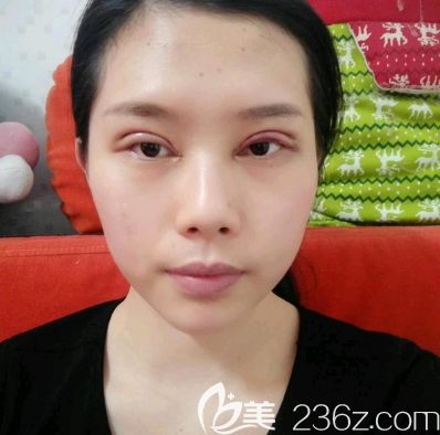 廣州韓妃雙眼皮術(shù)后兩天效果 廣州韓妃雙眼皮術(shù)后兩天效果
