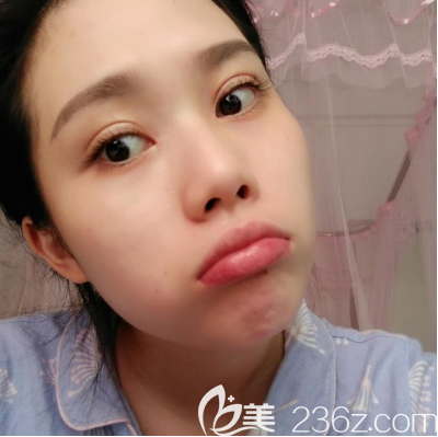 廣州韓妃于洪瑞醫(yī)生做雙眼皮怎么樣 廣州韓妃于洪瑞醫(yī)生做雙眼皮怎么樣