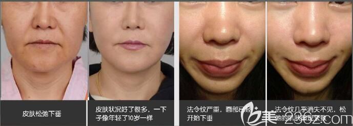 楊歡臘醫(yī)生除皺案例對比 楊歡臘醫(yī)生除皺案例對比