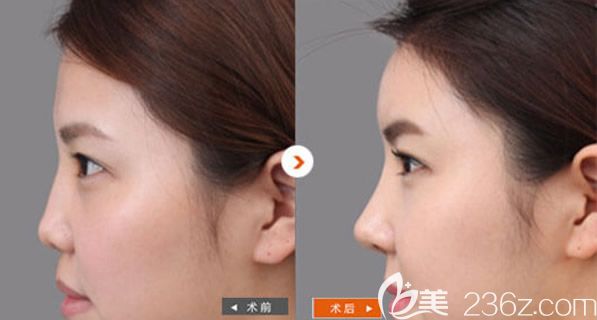 包頭華美整形李成飛醫(yī)生自體軟骨綜合隆鼻案例