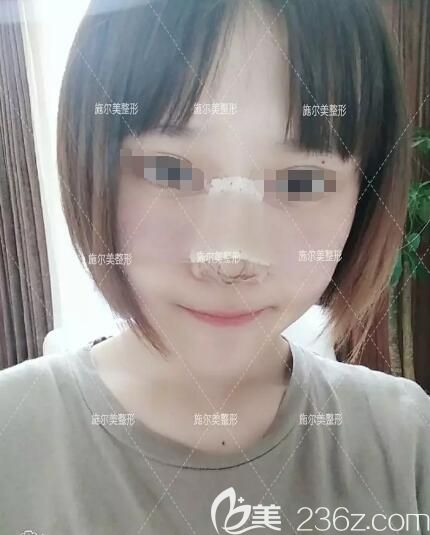 耳軟骨隆鼻術(shù)后一周恢復(fù)狀態(tài)