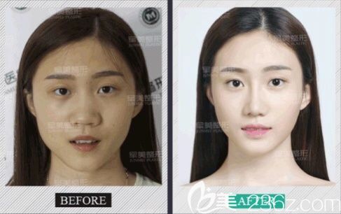 重慶軍美哪個(gè)醫(yī)生隆鼻好