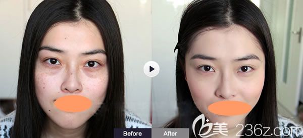 西寧康華醫(yī)院整形祛斑案例效果展示