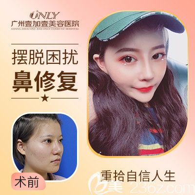 廣州壹加壹李明隆鼻失敗修<span style=