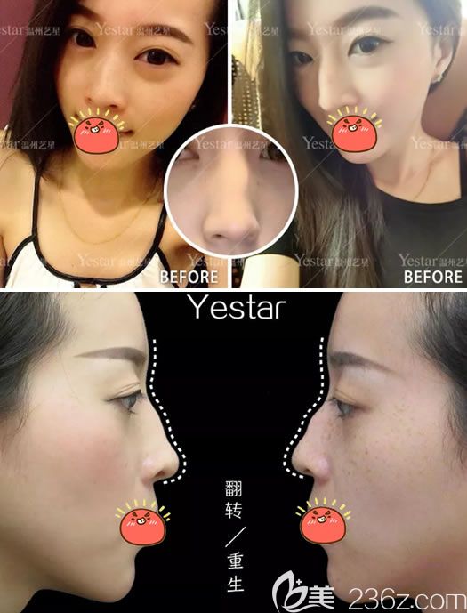 溫州藝星做駝峰鼻矯正術(shù)前 溫州藝星做駝峰鼻矯正術(shù)前