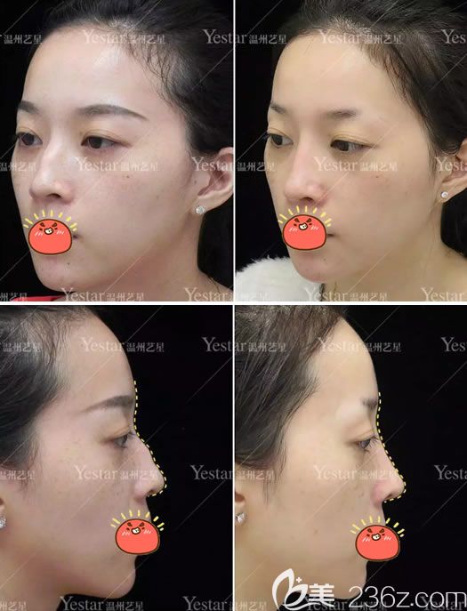 溫州藝星駝峰鼻矯正<span style= 溫州藝星駝峰鼻矯正<span style=