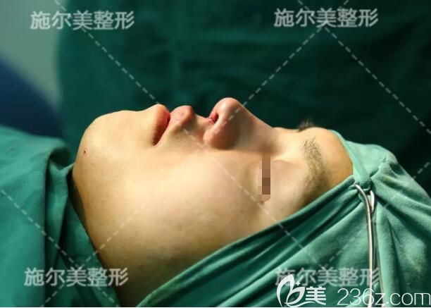 剛做完肋軟骨隆鼻術(shù)后即刻效果 剛做完肋軟骨隆鼻術(shù)后即刻效果