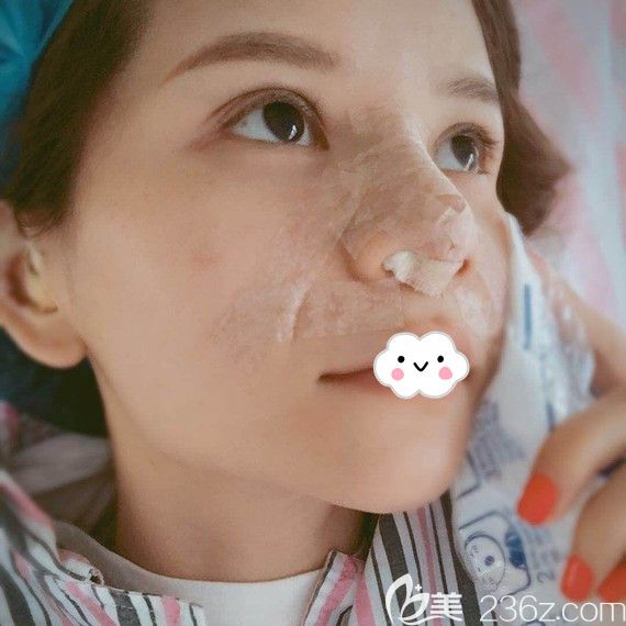 <!--<i data=20240703-sp></i>-->假體墊鼻基底+耳軟骨墊鼻尖案例 <!--<i data=20240703-sp></i>-->假體墊鼻基底+耳軟骨墊鼻尖案例