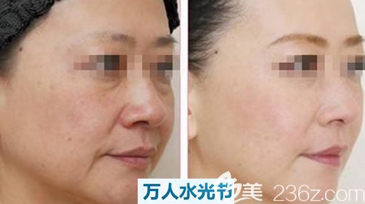 嘉興禾美無水水光美膚案例