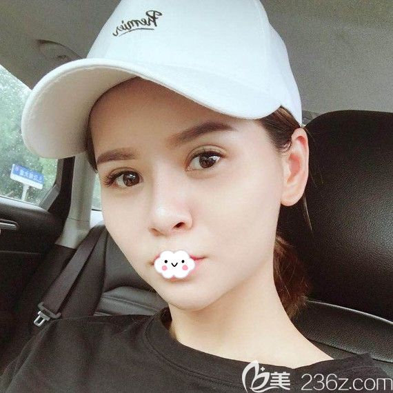 <!--<i data=20240703-sp></i>-->俞靜鼻綜合術(shù)后恢復(fù)效果 <!--<i data=20240703-sp></i>-->俞靜鼻綜合術(shù)后恢復(fù)效果