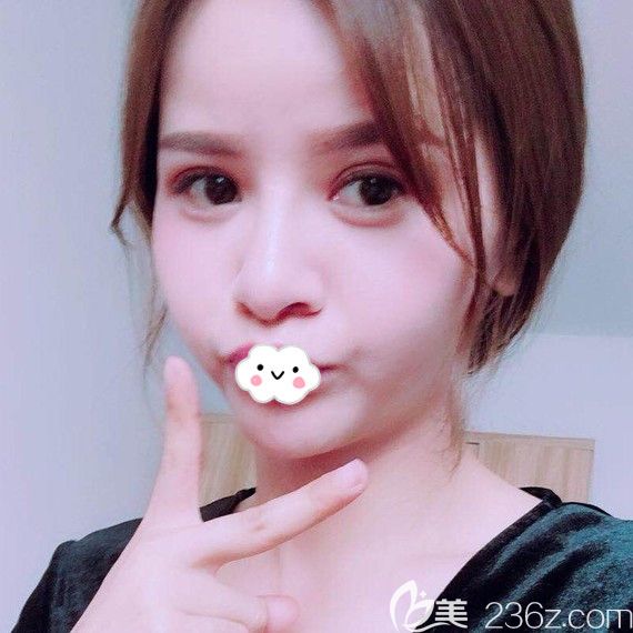 <!--<i data=20240703-sp></i>-->假體隆鼻綜合整形案例恢復(fù)效果圖 <!--<i data=20240703-sp></i>-->假體隆鼻綜合整形案例恢復(fù)效果圖