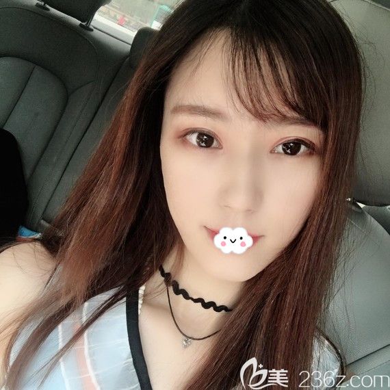 武漢自體脂肪面部填充哪家好？美麗力量案例恢復(fù)圖