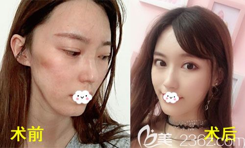 <!--<i data=20240703-sp></i>-->自體脂肪移植填充全臉前后效果對(duì)比圖