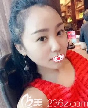 在石家莊藍(lán)山做眼綜合術(shù)前雙眼皮較窄 在石家莊藍(lán)山做眼綜合術(shù)前雙眼皮較窄