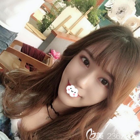 現(xiàn)將我找整形美容做自體脂肪面部填充案例恢復(fù)過程圖公開