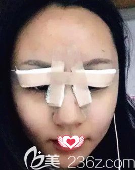 王興奎院長(zhǎng)為我剛做完眼綜合術(shù)后眼睛腫脹 王興奎院長(zhǎng)為我剛做完眼綜合術(shù)后眼睛腫脹