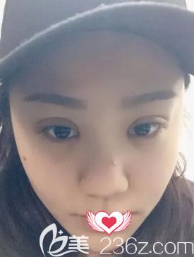 在石家莊藍(lán)山做眼綜合術(shù)后7天進(jìn)行拆線 在石家莊藍(lán)山做眼綜合術(shù)后7天進(jìn)行拆線