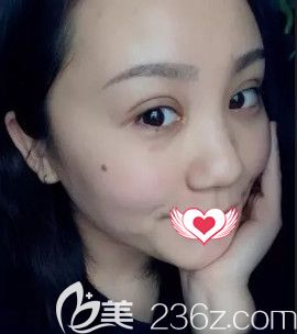 王興奎院長(zhǎng)做眼綜合術(shù)后15天眼睛消腫 王興奎院長(zhǎng)做眼綜合術(shù)后15天眼睛消腫