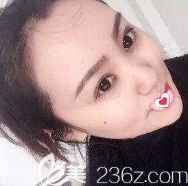 自從在石家莊藍(lán)山做完雙眼皮+開(kāi)眼角手術(shù)后 再也不用羨慕人家的芭比大眼