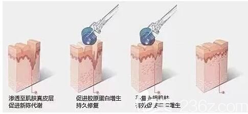 微針的治療原理