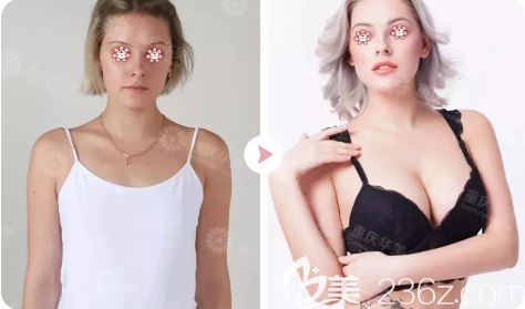 重慶華美假體豐胸案例