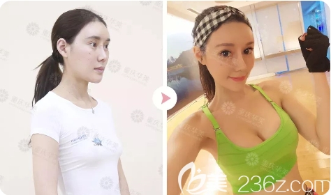 重慶華美陳德法隆胸怎么樣