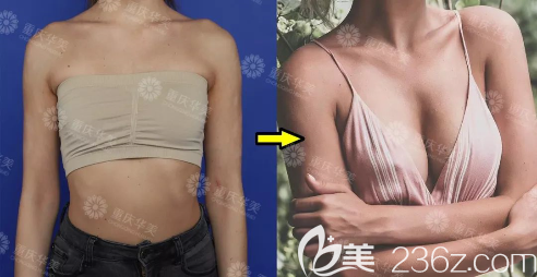 重慶華美陳德法假體豐胸案例展示