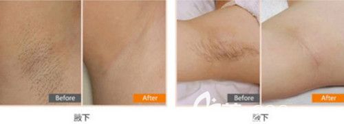 巧致整形醫(yī)院脫腋毛案例