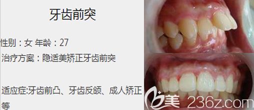 程玲隱形矯正矯正案例 程玲隱形矯正矯正案例