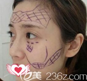 訾海濤醫(yī)生為我做脂肪填充前進行劃線設計