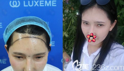 杭州連天美鄭云瑤植發(fā)案例 杭州連天美鄭云瑤植發(fā)案例