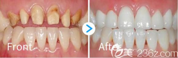 諾德齒科烤瓷牙修復(fù)前后對(duì)比效果