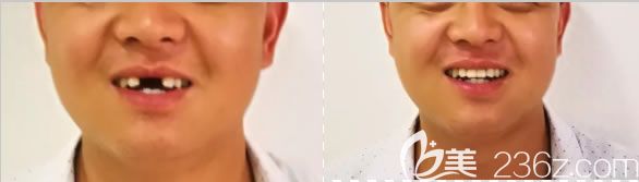 深圳諾德齒科朱俊前門牙缺失2顆種植案例圖 深圳諾德齒科朱俊前門牙缺失2顆種植案例圖