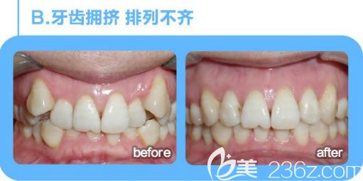 文梁醫(yī)生牙齒擁擠和虎牙矯正后的對(duì)比效果 文梁醫(yī)生牙齒擁擠和虎牙矯正后的對(duì)比效果