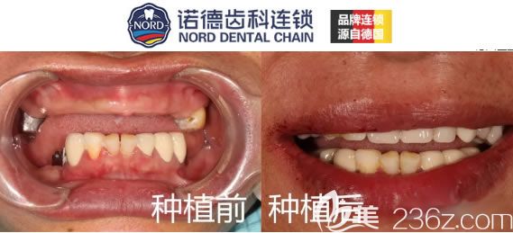 深圳諾德齒科周森半口種植牙案例圖 深圳諾德齒科周森半口種植牙案例圖