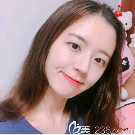 在廣州紫馨做雙眼皮的術前照片 在廣州紫馨做雙眼皮的術前照片