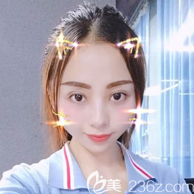 找廣州紫馨李政祐做雙眼皮修復7天拆線 找廣州紫馨李政祐做雙眼皮修復7天拆線