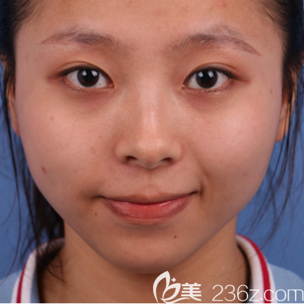 廣州紫馨雙眼皮修復術前照片 廣州紫馨雙眼皮修復術前照片