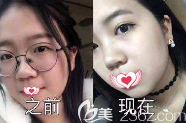 王興奎院長做雙眼皮案例 王興奎院長做雙眼皮案例