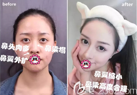 貴陽美貝爾隆鼻好不好