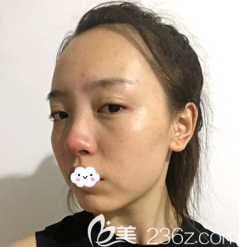 <!--<i data=20240703-sp></i>-->耳軟骨隆鼻術(shù)后8天恢復(fù)照片