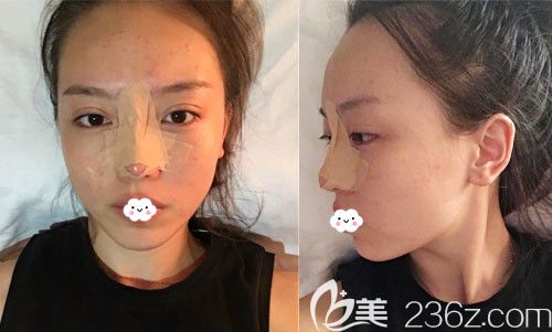 <!--<i data=20240703-sp></i>-->耳軟骨隆鼻術(shù)后第1天效果