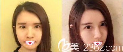 醫(yī)生做鼻綜合案例 醫(yī)生做鼻綜合案例