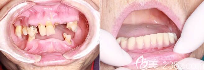 深圳諾德齒科柯明院長(zhǎng)7旬老人即刻種植牙案例