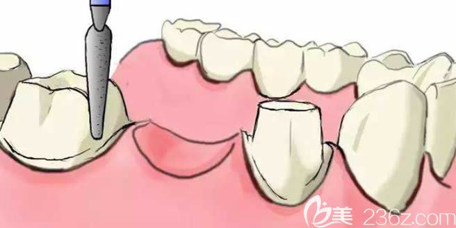 柯明醫(yī)生科普關(guān)于種植牙的知識(shí)